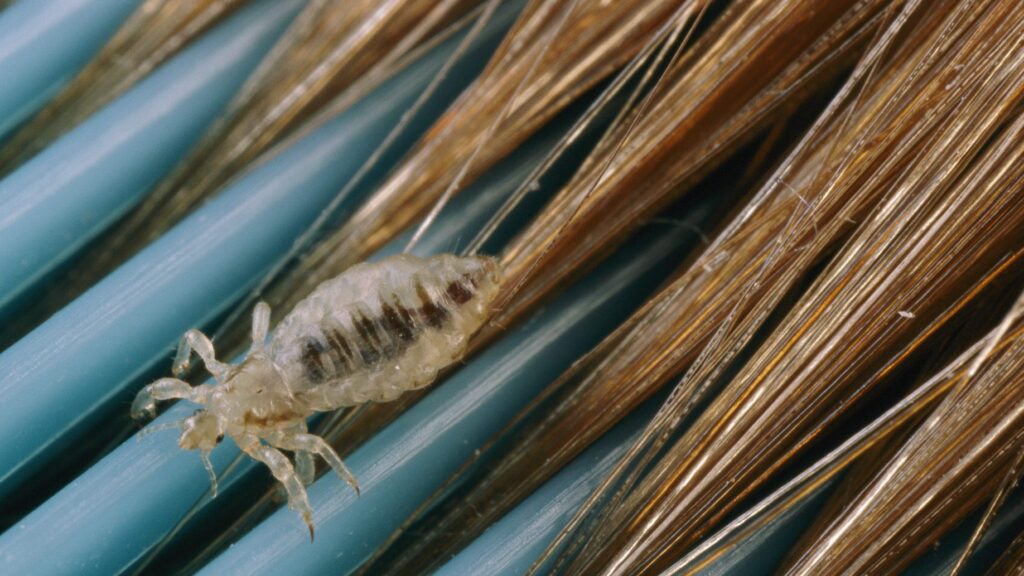 Lice being removed from the hair follicle