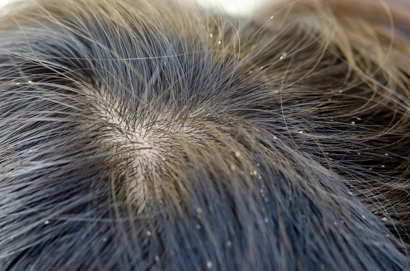 human scalp showing a single lice