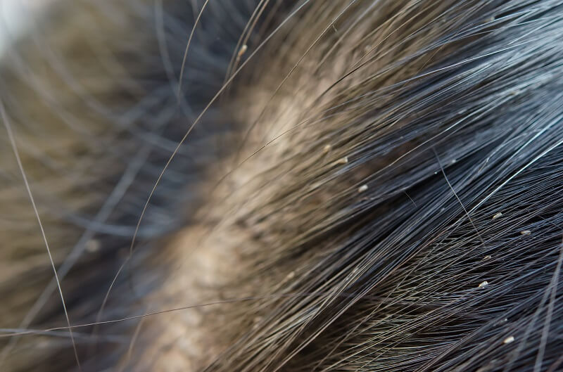 recurring lice infestations